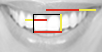 Teeth and Phi segments